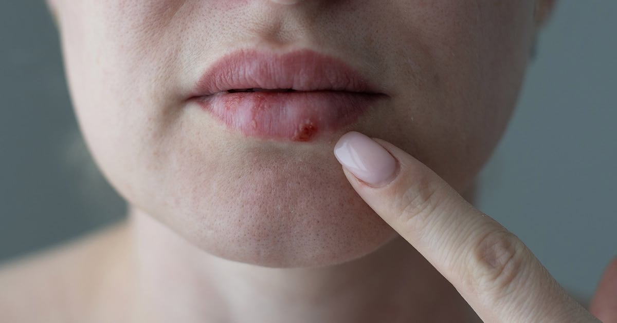 Un antiviral distinto para cuando el herpes no se va: la FDA aprobó el pritelivir, el primer fármaco oral nuevo en casi treinta años