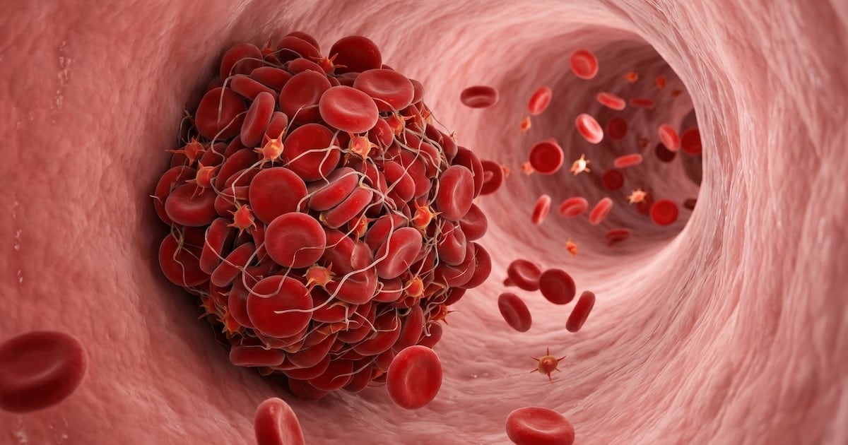 Cuando la sangre se traba: cómo reconocer a tiempo un coágulo y por qué a veces el cuerpo avisa tarde